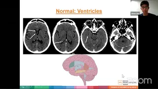 Basic Interpretation of the CT Brain