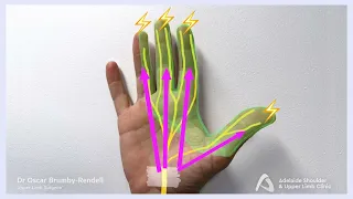 Carpal Tunnel Syndrome