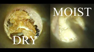 DRY vs MOIST Ear WAX Removal :  4K/HD