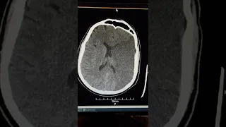 Left MCA territory CVA/ ischemic stroke ct scan,cytotoxic edema( both white/gray matter hypodensity)