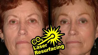 Is CO2 Fractional Laser Resurfacing WORTH IT? Plastic Surgeon Answers