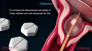 New #UOGJournal video abstract on foley catheter vs oral misoprostol