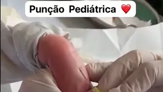 Punção venosa pediátrica #acessovenoso #veia #pediatria #punção