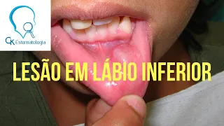 Comentário caso clínico Lesão em lábio inferior - Mucocele