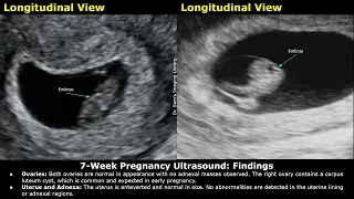 7 Week Pregnancy Obstetric Ultrasound Report Example | Normal Intrauterine Pregnancy USG Reporting