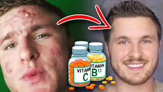 These Vitamins Are Proven To ELIMINATE Acne! 😱💊