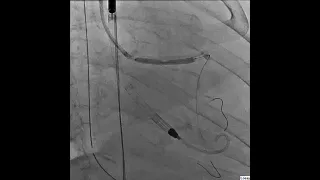 Shockwave Intravascular Lithotripsy: 3.5 mm × 40 mm Shockwave Balloon in the Distal LMCA to LAD