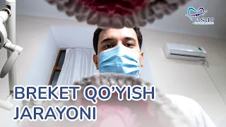 Breket qo’yish jarayoni