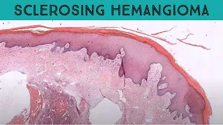 Polypoid Dermatofibroma, aneurysmal type (aka sclerosing "hemangioma”) pathology dermatology