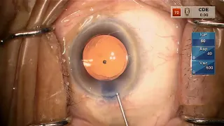 Corneal Endothelial Avulsion During Cataract Surgery