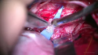 Right a3 AICA-p3 PICA In Situ Bypass, Trapping, and Thrombectomy of AICA Aneurysm