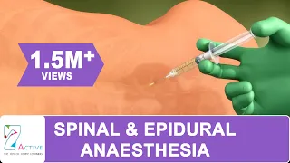 SPINAL & EPIDURAL ANAESTHESIA