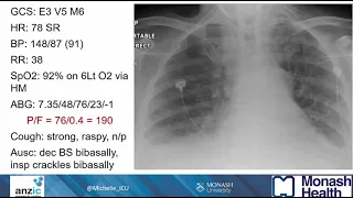 OPTIMISATION OF RESPIRATORY SUPPORT   ISICEM 2024