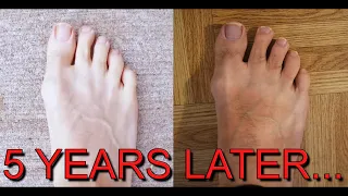 Incredible 5 Year Transformation Wearing Barefoot Shoes!