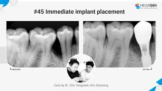 Dr. Yongseok CHO, Sewoung KIM, #45 Immediate implant surgery and prosthesis