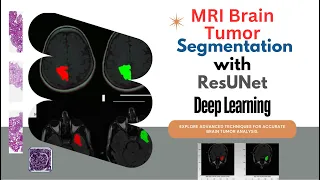 MRI Brain Tumor Segmentation Using ResUNet Deep Learning Architecture