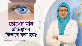 চোখের মনি প্রতিস্থাপন কিভাবে করা হয়? Corneal transplantation