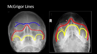 Facial Bones  Part 1