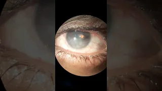 Intraocular foreign body, globe perforation