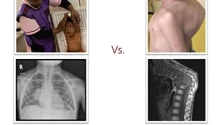 Regimen Design and Dosing for Children with DR-TB: A Case-Based Discussion