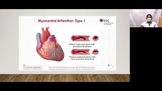 Updates in the management of Acute Coronary Syndrome- Dr  Nathaniel