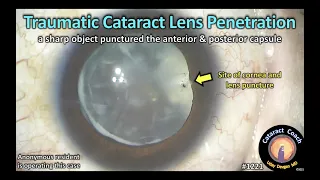 CataractCoach 1221: traumatic cataract lens penetration