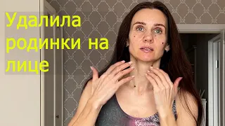 Удалила РОДИНКИ на лице. Что самое сложное. Реальный отзыв. Неприятный момент.