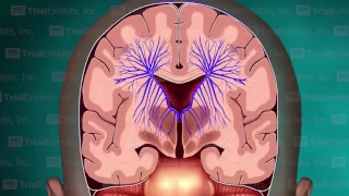 Deep Medullary Thrombosis