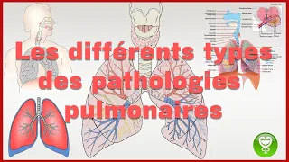 Comprendre les différents types de pathologies pulmonaires en 12 minutes