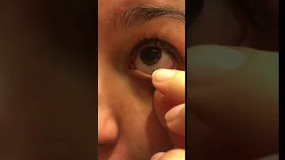 Satisfying Eye String Removal From Eye Allergies