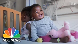 Twin Sisters Conjoined At The Head Successfully Separated By Surgery | NBC News NOW