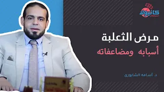 أسباب ومضاعفات مرض الثعلبة مع د. أسامه الشابورى