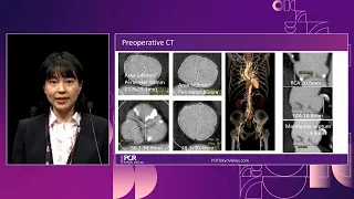 The optimal first valve choice for patients with aortic stenosis - PCR Tokyo Valves 2024