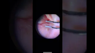 Meibomian gland extraction