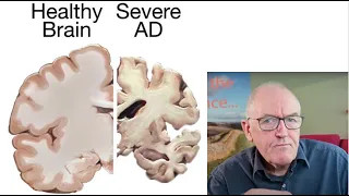 Common deficiency and dementia