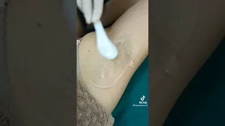 جلسه ليزر under arm..النتيجه مبهره..مين جربت الليزر ؟!