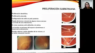 Proliferación vítreo-retiniana. Dra. Gusmary Hernández