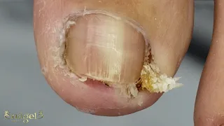 🤤O VÍDEO MAIS SATISFATÓRIO DE UNHA ENCRAVADA QUE VOCÊ JÁ VIU #ingrowntoenail #nails