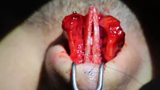 Rhinology 2015   video 2