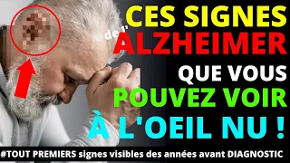 4 signes visibles à l'oeil nu et précoce de la maladie de l'Alzheimer