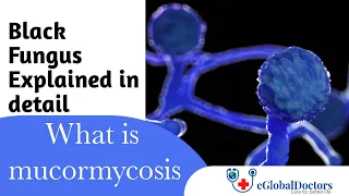 What Is Black Fungus ? | Explained in detail | Full Webinar On Mucormycosis | eGlobalDoctors