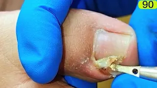 90-Perfect process, ingrown