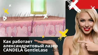 Как работает александритовый лазер CANDELA ⚡ animation laser hair removal