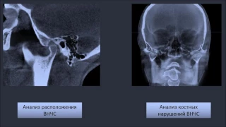 Цефалометрический анализ при планировании ортопедического лечения