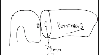 Whipple Procedure Pancreatic Anastomotic Techniques Part # 1