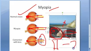 Ophthalmology 048 a Myopia Short Sightedness Eye Near Sight