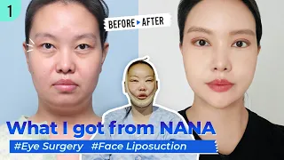 [SUB] Mom of two's journey at Nana Hospital | Face Liposuction, Incisional Double Eyelid and more!