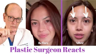 Getting Eyelid Surgery (Blepharoplasty) | Plastic Surgeon Reacts