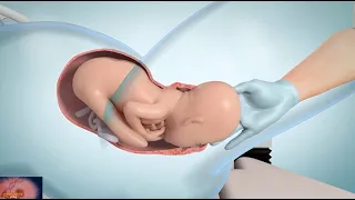 What Happens During Labor: Stages 2 & 3 | Stages of Labor 3D Animation |