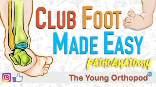 CLUB FOOT Pathoanatomy Made Easy - The Young Orthopod